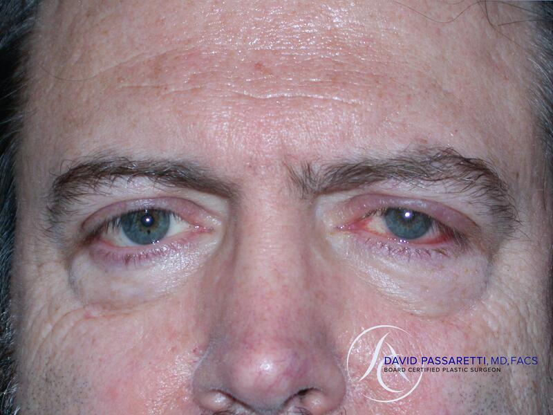 Eyelid surgery before & after photo