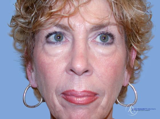 Eyelid surgery Before & After photo