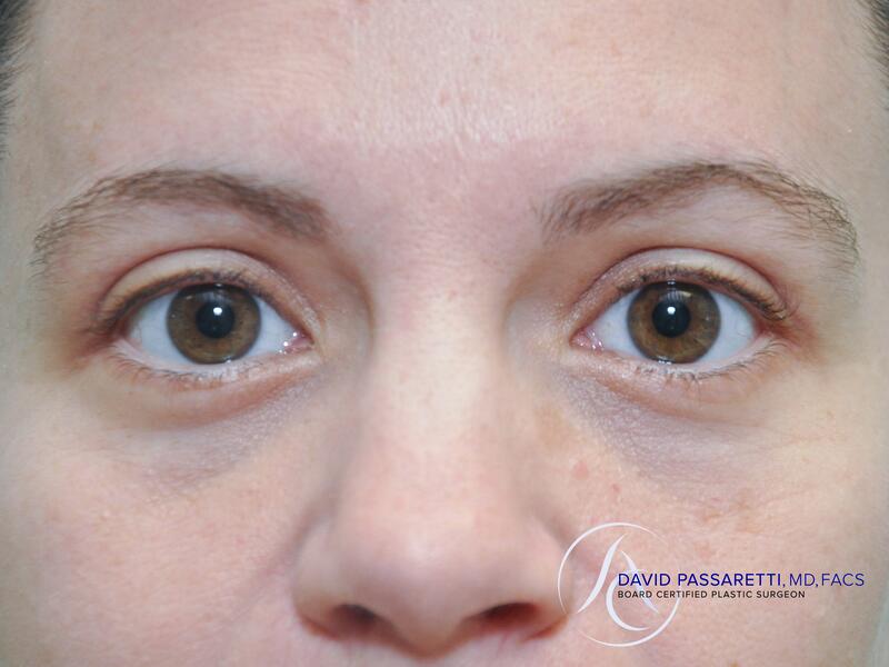 Eyelid surgery before & after photo