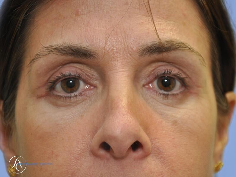 Eyelid surgery before & after photo