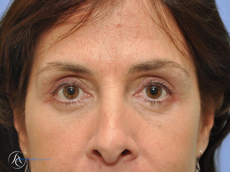 Eyelid surgery before & after photo