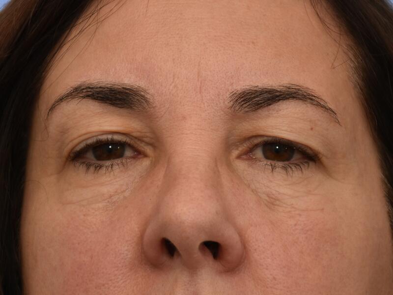 Eyelid surgery before & after photo