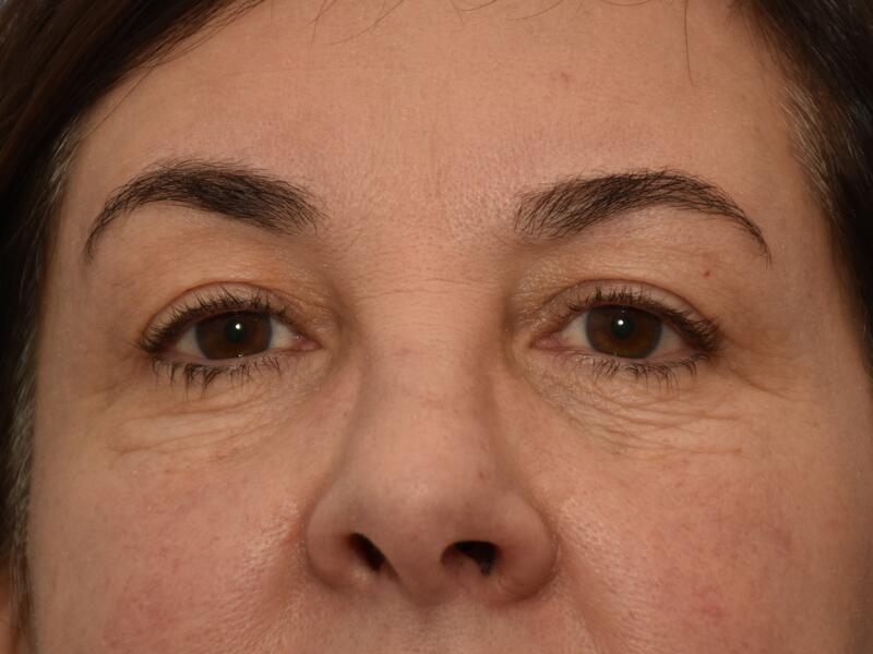 Eyelid surgery before & after photo