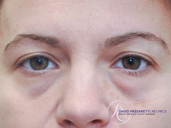 Eyelid surgery before & after photo