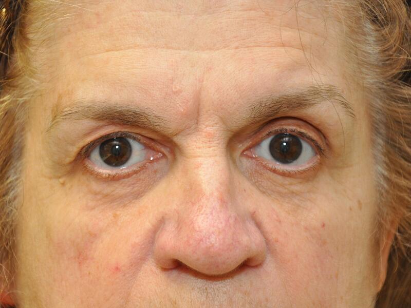 Eyelid surgery before & after photo