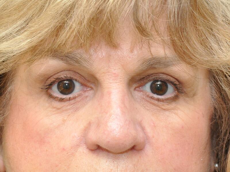 Eyelid surgery before & after photo