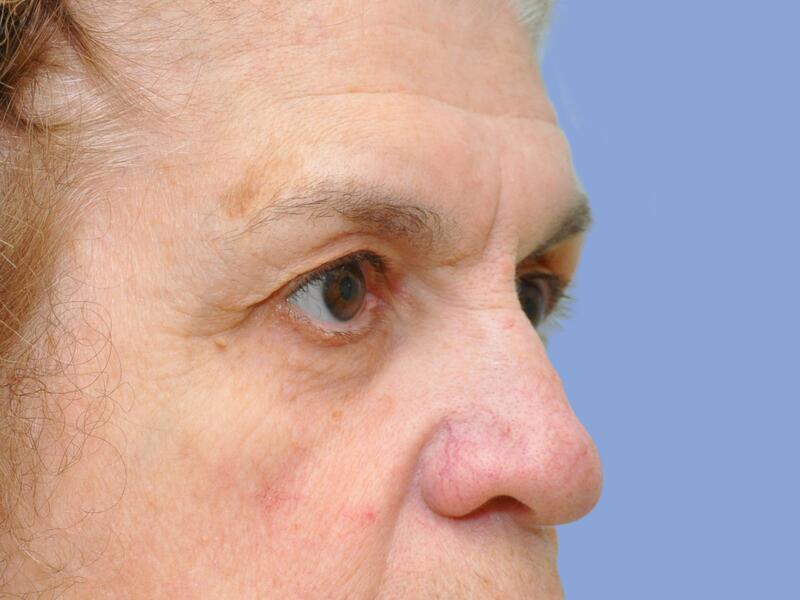 Eyelid surgery before & after photo