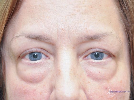 Eyelid surgery Before & After photo