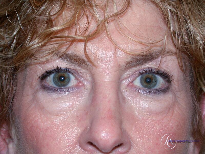 Eyelid surgery before & after photo