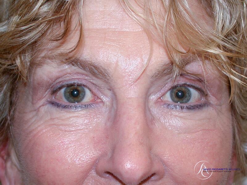 Eyelid surgery before & after photo