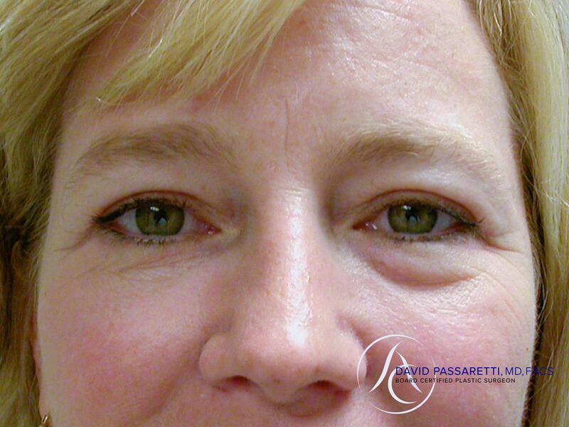 Eyelid surgery before & after photo