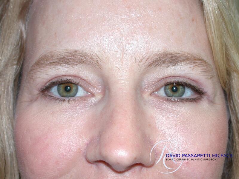 Eyelid surgery before & after photo