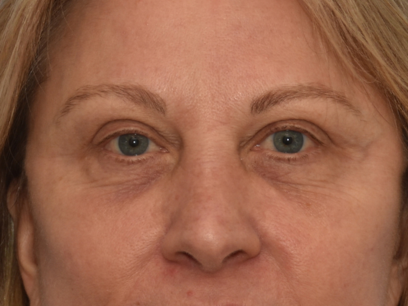 Eyelid surgery before & after photo