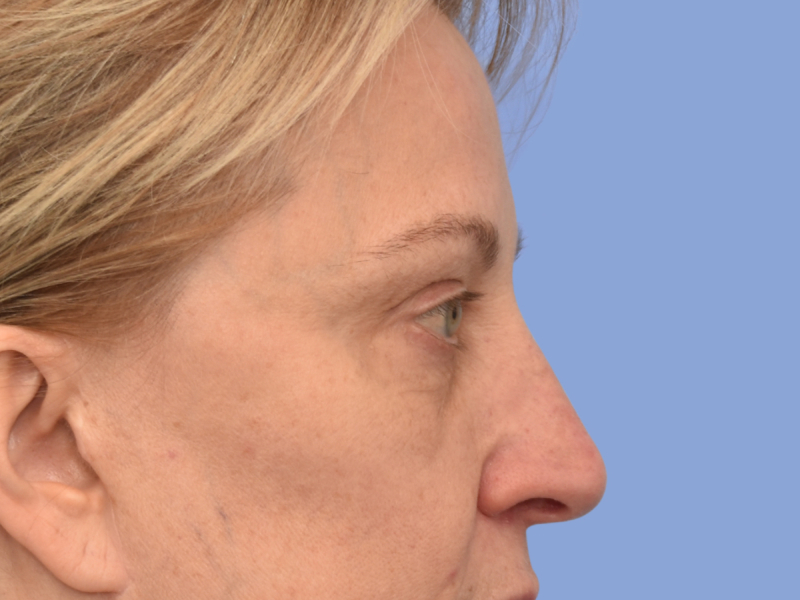Eyelid surgery before & after photo