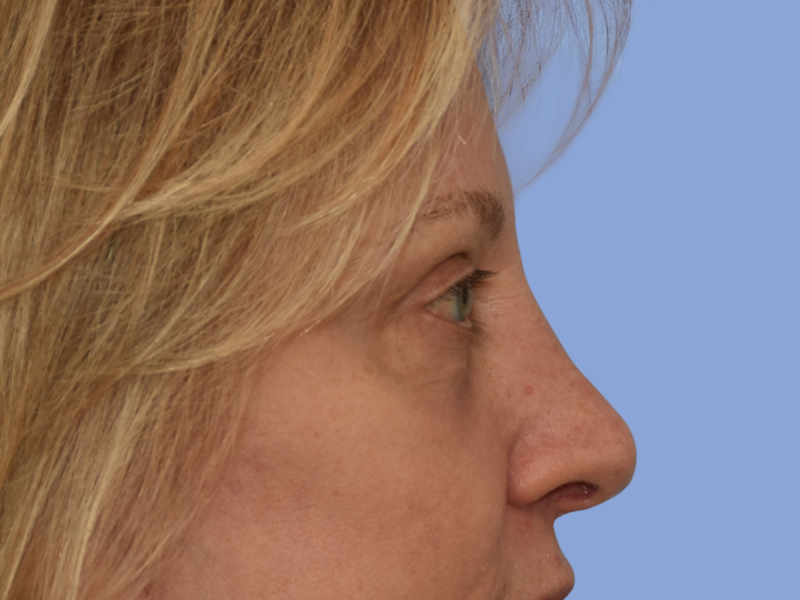 Eyelid surgery before & after photo