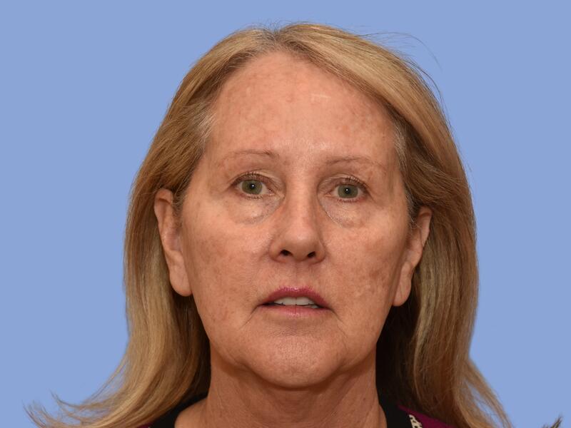 Facelift before & after photo