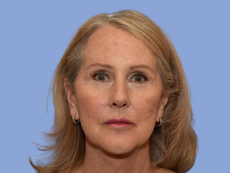 Facelift before & after photo