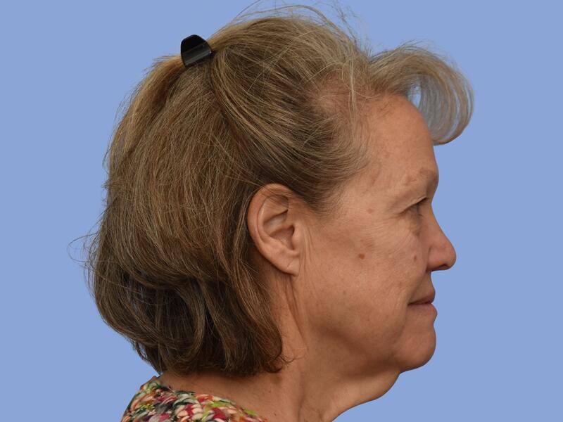 Facelift before & after photo