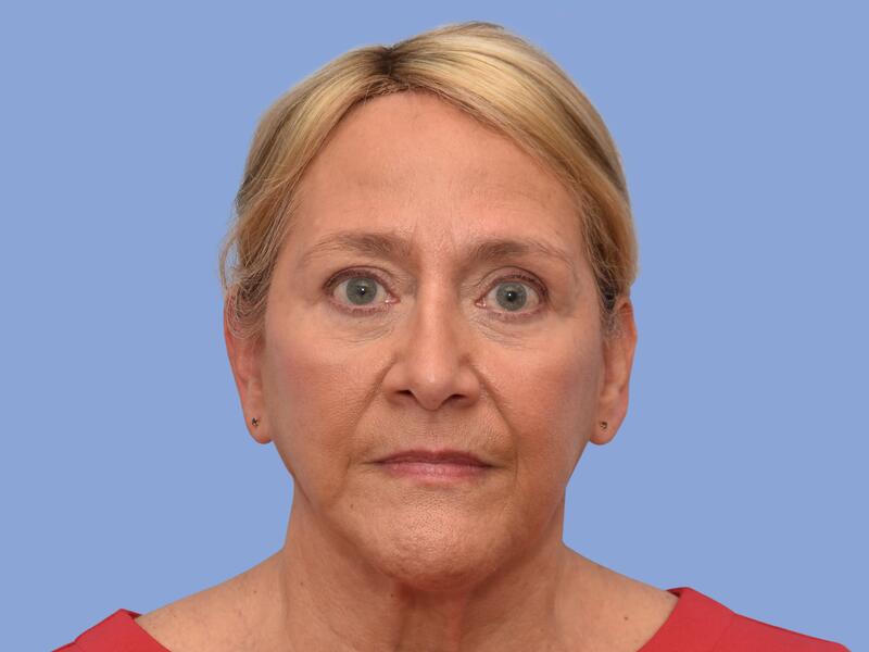 Facelift before & after photo