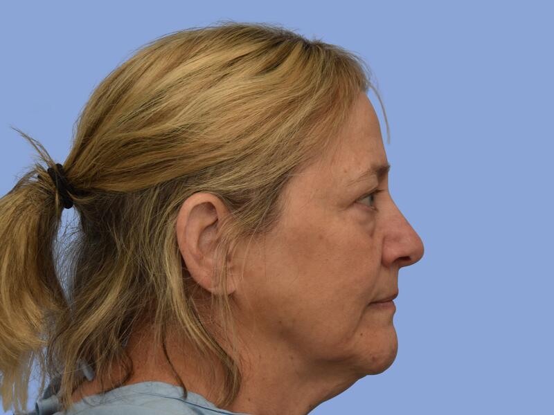 Facelift before & after photo