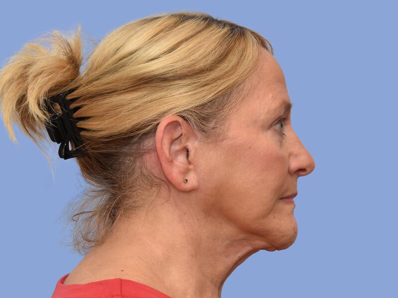 Facelift before & after photo