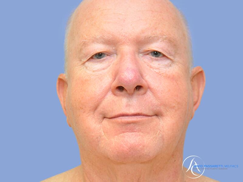 Facelift before & after photo