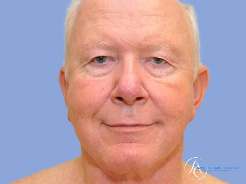 Facelift before & after photo