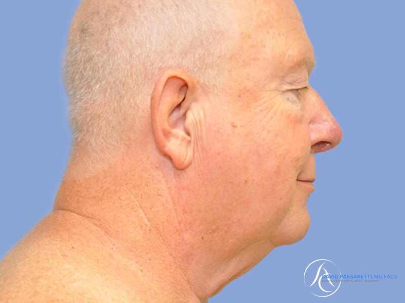 Facelift before & after photo