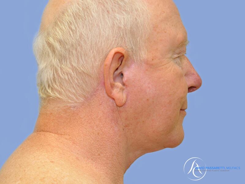 Facelift before & after photo