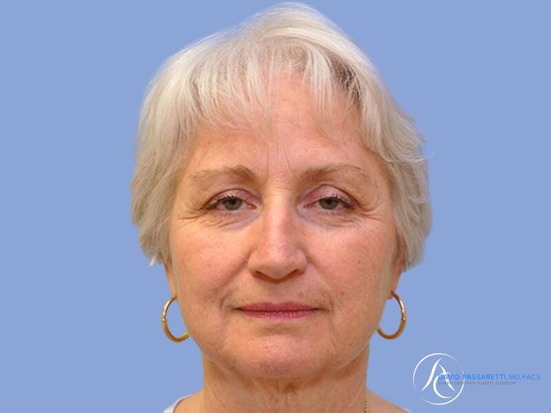 Facelift before & after photo