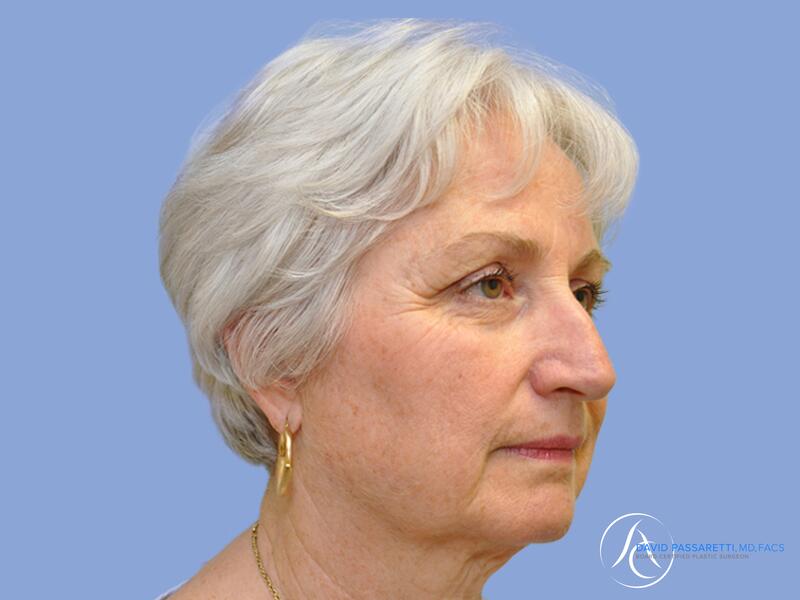 Facelift before & after photo