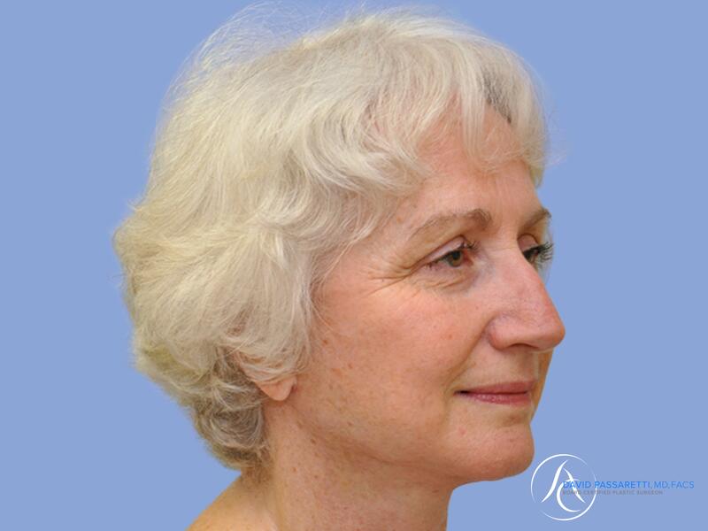 Facelift before & after photo