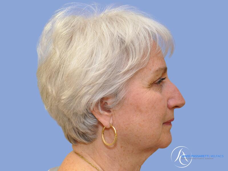 Facelift before & after photo