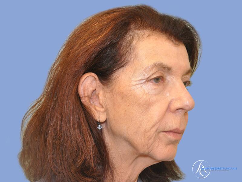 Facelift before & after photo