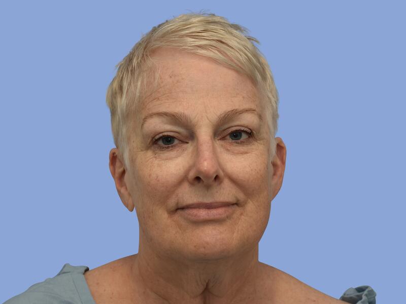 Facelift before & after photo