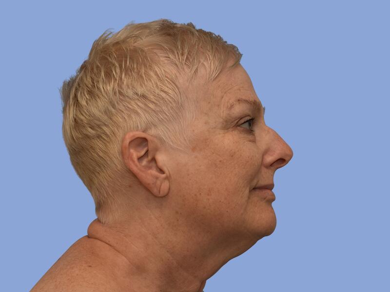 Facelift before & after photo