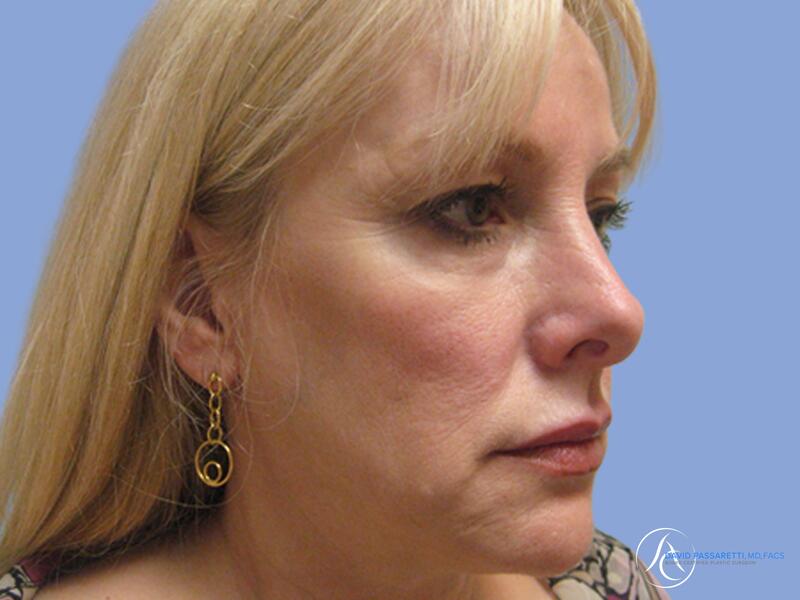 Facelift before & after photo