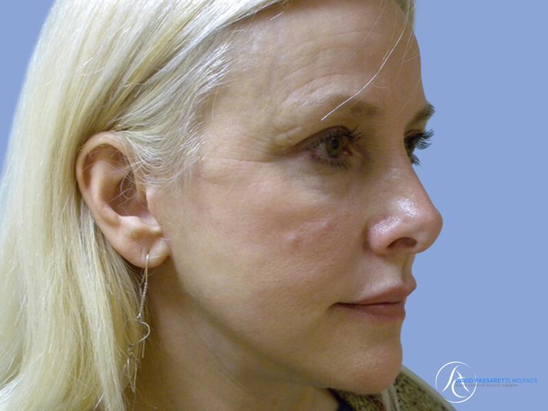 Facelift before & after photo