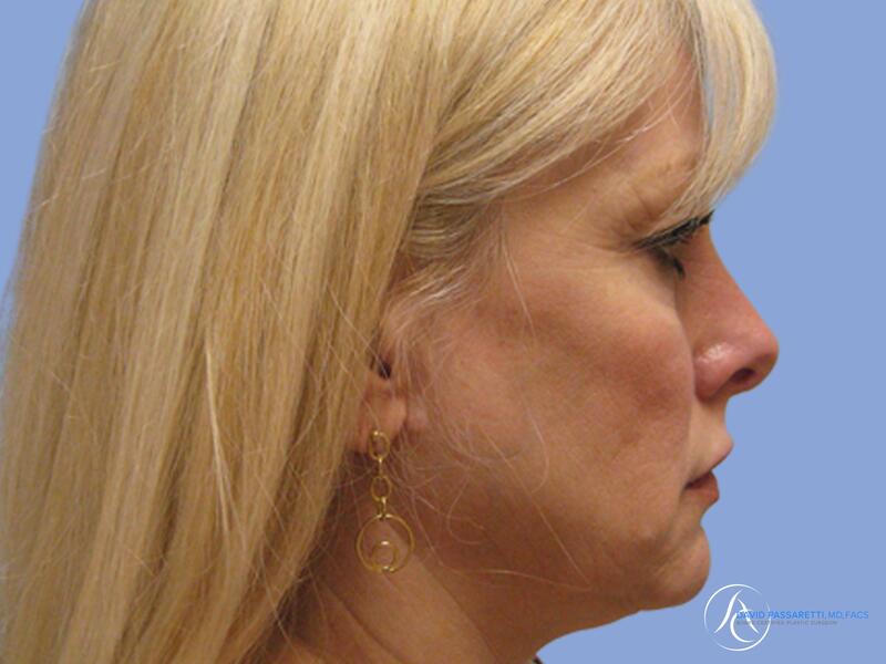 Facelift before & after photo