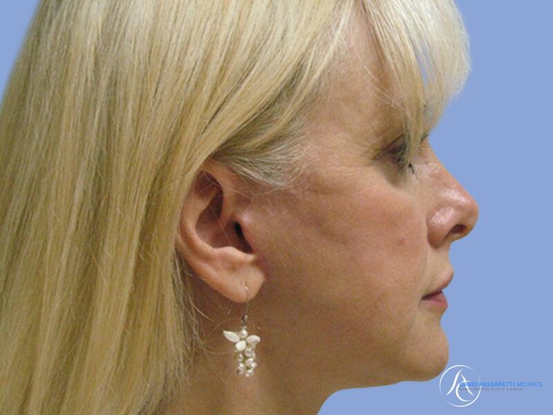 Facelift before & after photo