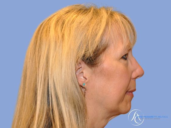 Facelift before & after photo