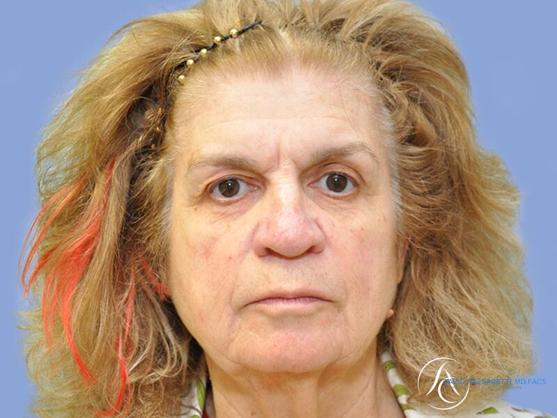 Facelift before & after photo