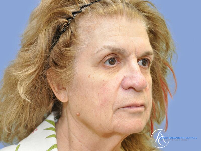 Facelift before & after photo