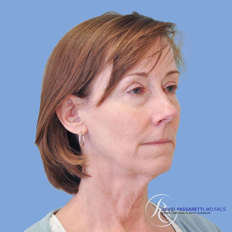 Facelift before & after photo