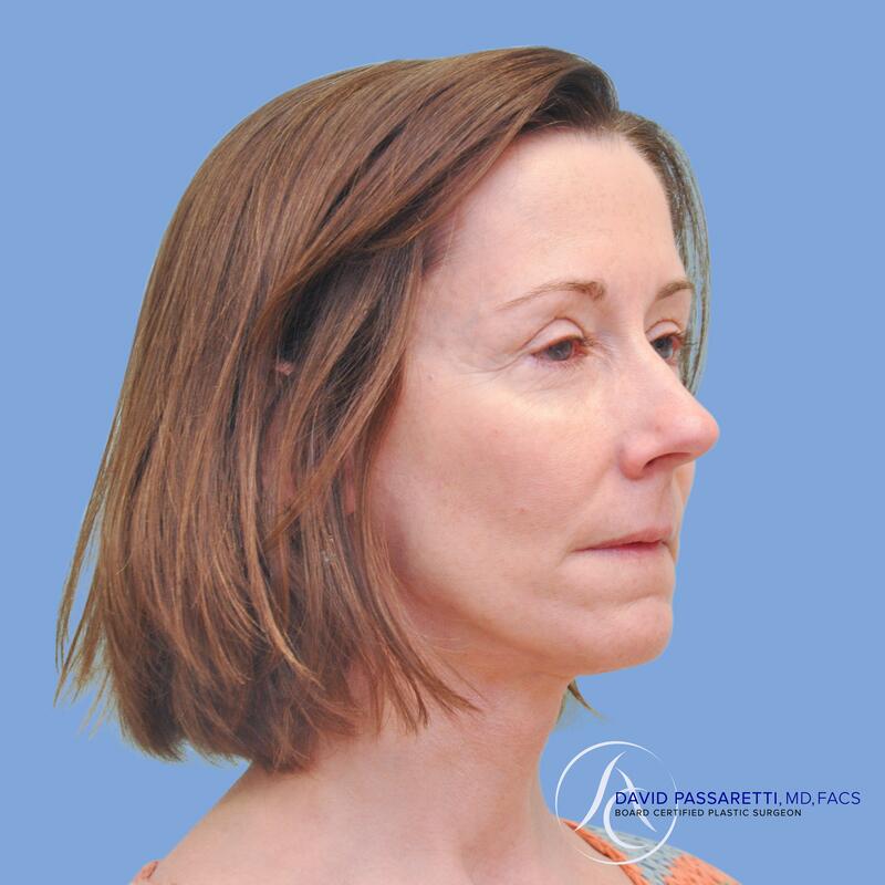 Facelift before & after photo