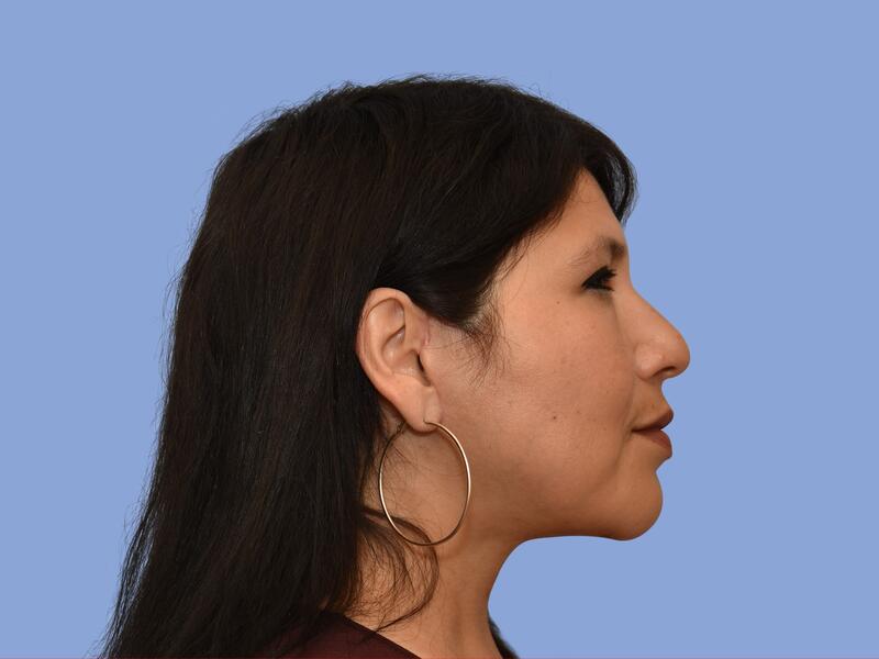 Facelift before & after photo