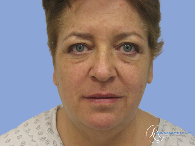 Facelift before & after photo