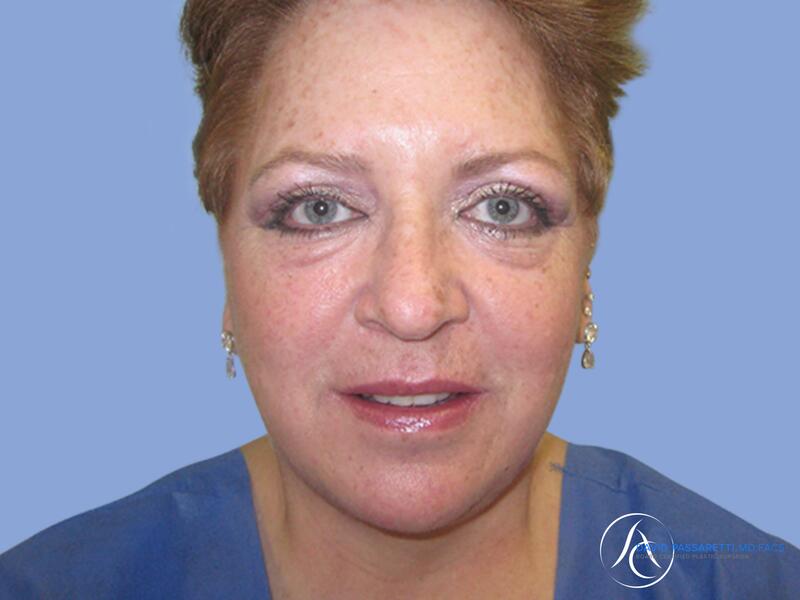 Facelift before & after photo