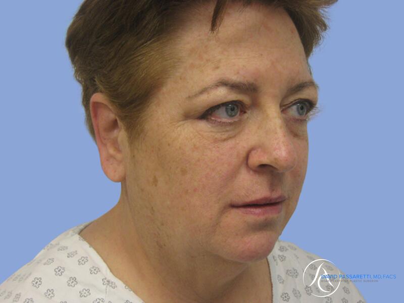 Facelift before & after photo