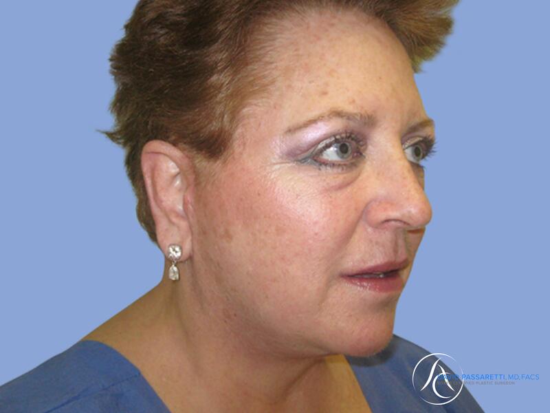 Facelift before & after photo